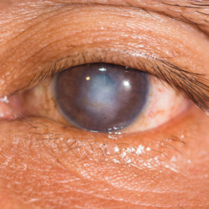 close up of the corneal scar during eye examination.